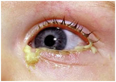 Fungal-eye-infections