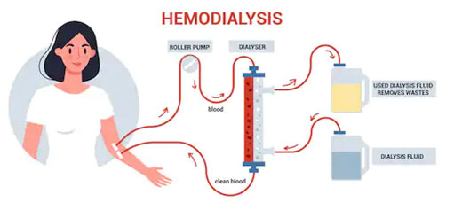 Hemodialysis