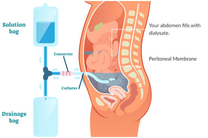 Peritoneal-dialysis