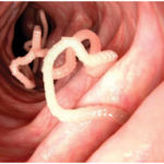 Intestinal Worms in Human beings